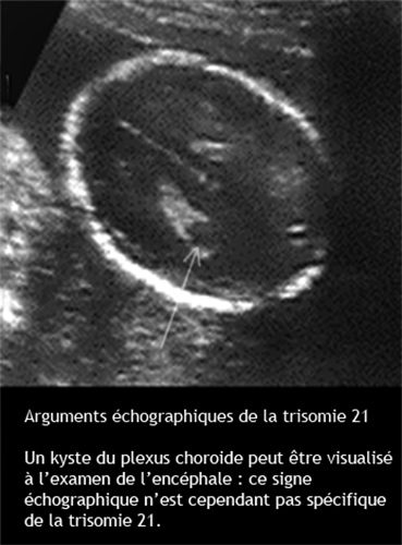 Trisomie 21 — syndrome de Down dysmorphie faciale caractéristiques 11