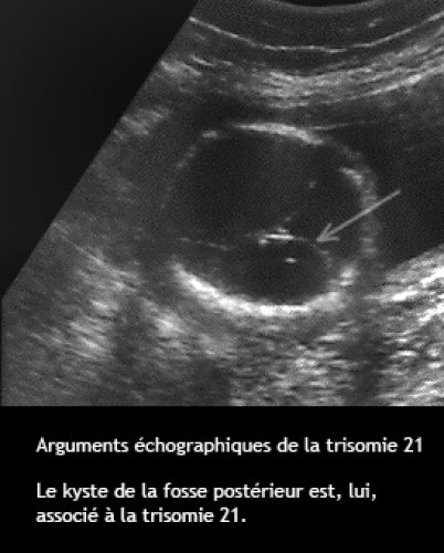Trisomie 21 — syndrome de Down dysmorphie faciale caractéristiques 12