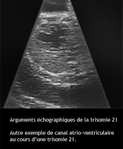 Trisomie 21 — syndrome de Down dysmorphie faciale caractéristiques 13
