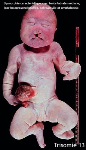 Trisomie 13 (syndrome de Patau) : dysmorphie cranio-faciale et signes échographiques