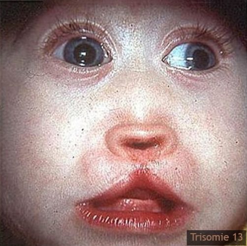 Trisomie 13 : malformations viscérales et polydactylie postaxiale (syndrome de Patau)