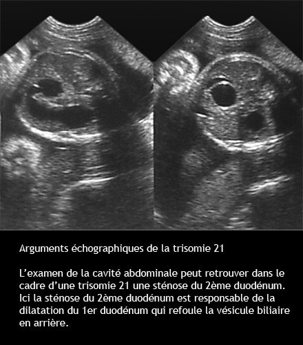 Trisomie 21 — syndrome de Down dysmorphie faciale caractéristiques 14