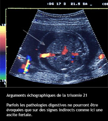 Trisomie 21 — syndrome de Down dysmorphie faciale caractéristiques 15