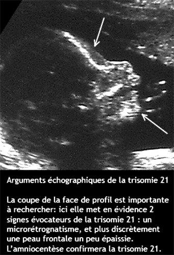 Trisomie 16