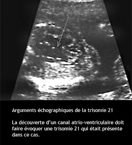 Trisomie 17