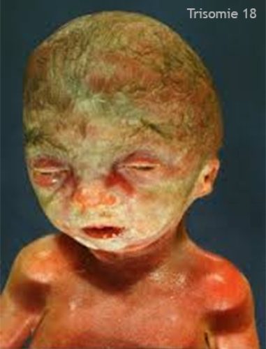 Trisomie 18 – dysmorphie crânio-faciale caractéristique