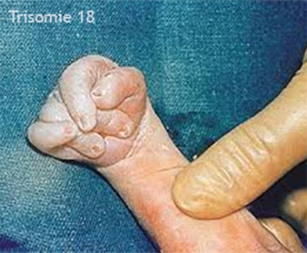 Trisomie 18 – anomalie des mains et pli palmaire unique