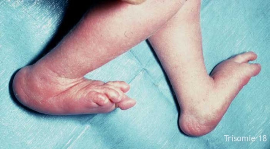 Trisomie 18 – anomalie des mains et pli palmaire unique