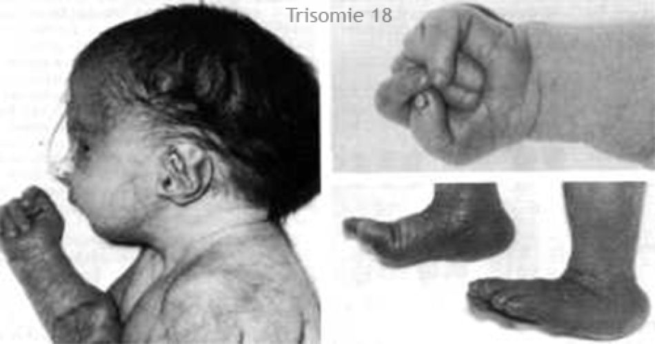 Trisomie 18 – dysmorphie crânio-faciale caractéristique