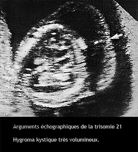 Trisomie 21 — syndrome de Down dysmorphie faciale caractéristiques 2