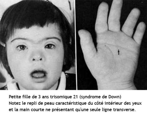 Trisomie 21_1