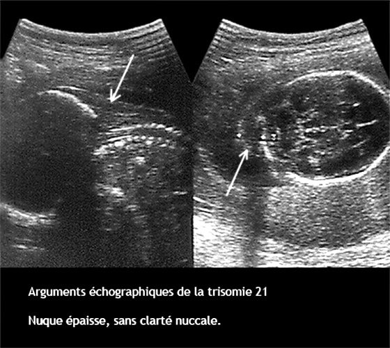 Trisomie 3