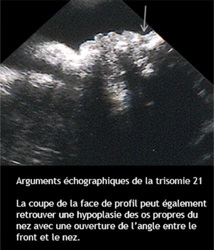Trisomie 21 — syndrome de Down dysmorphie faciale caractéristiques 4