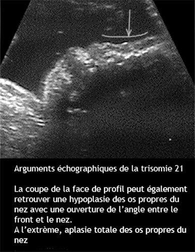 Trisomie 5