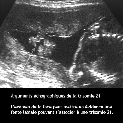 Trisomie 6