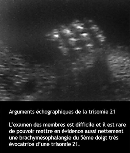 Trisomie 7