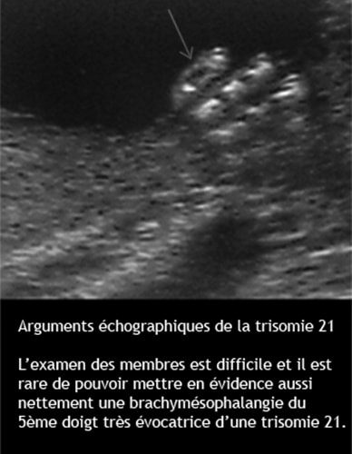 Trisomie 8