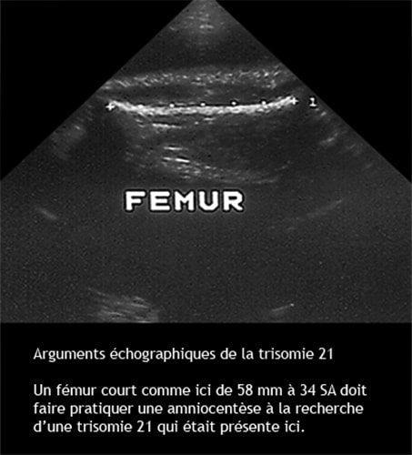 Trisomie 21 — syndrome de Down dysmorphie faciale caractéristiques 9