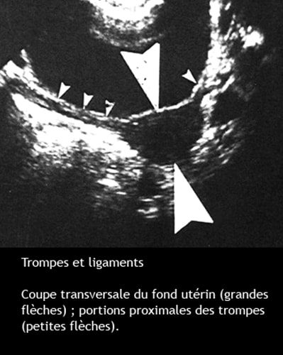 Trompes de Fallope — anatomie structure histologique tubaire 1