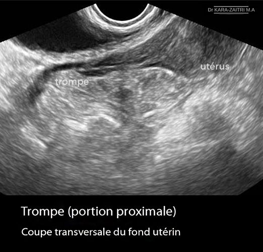 Trompes de Fallope — anatomie structure histologique tubaire 2