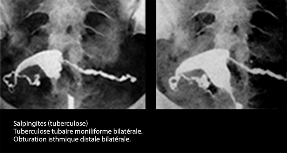 Tuberculose génitale 8