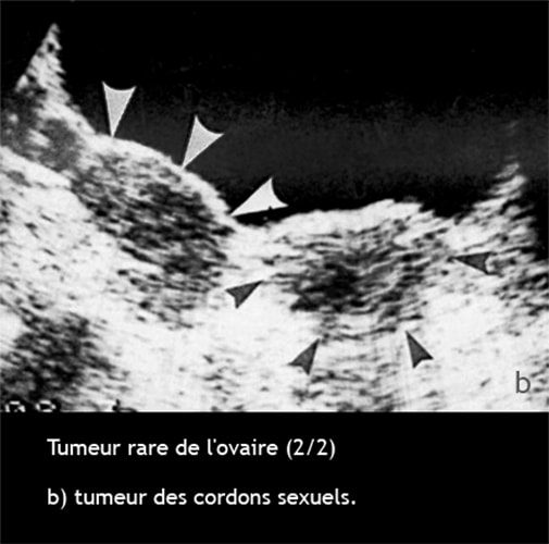 Tumeur ovaire cordons sexuels — tumeur stromale ovarienne