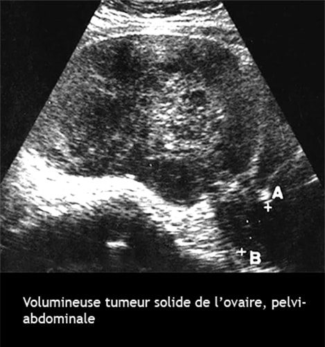 Tumeur solide de l'ovaire
