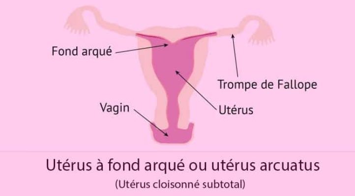 Malformations utérines_Utérus arcuatus
