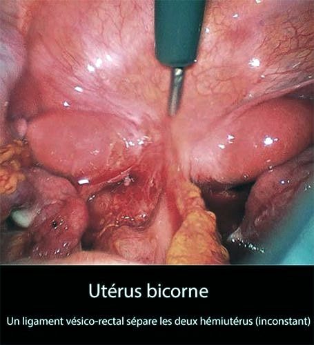 Utérus bicorne coelioscopie — malformation utérine congénitale müllérienne