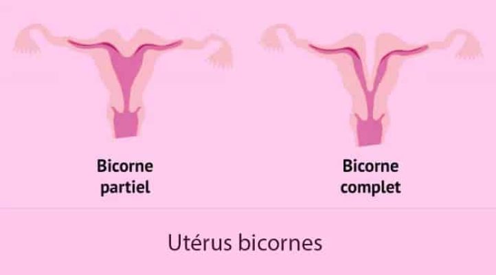 Malformations utérines_Utérus bicornes bis