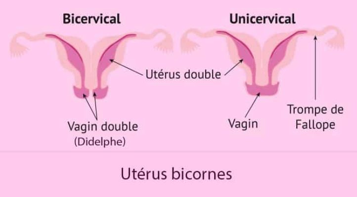 Malformations utérines_Utérus bicornes