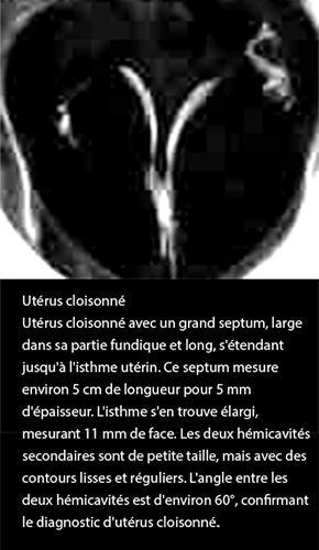 Utérus cloisonné 2