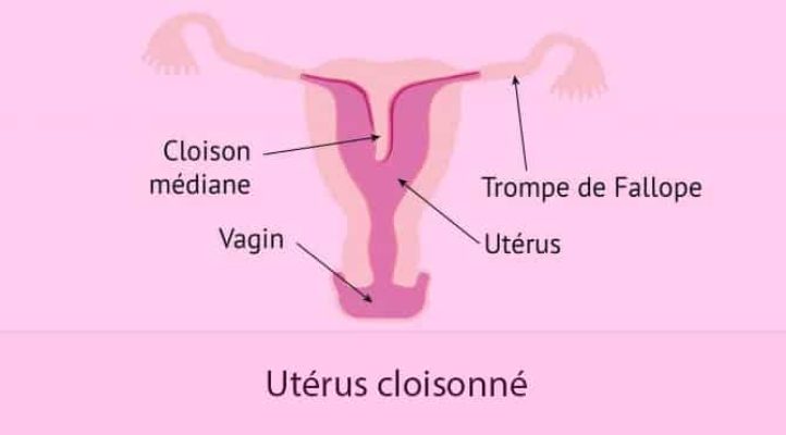 Malformations utérines_Utérus cloisonné