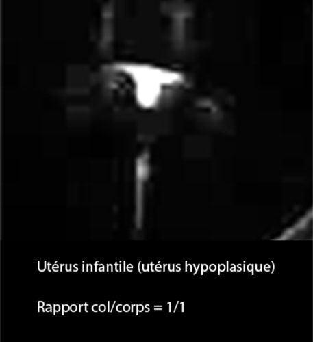 Utérus hypoplasique