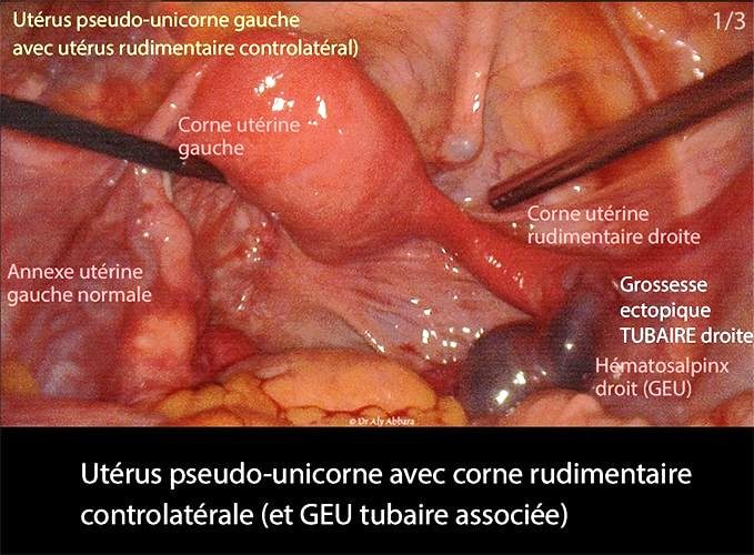 Utérus pseudo-unicorne coelioscopie — malformation utérine congénitale