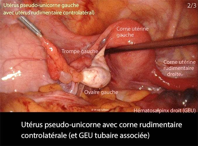 Utérus pseudo-unicorne 2_3 coelio