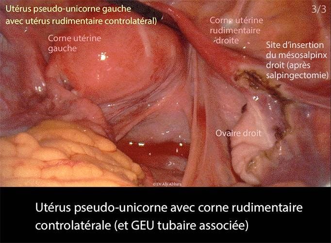 Utérus pseudo-unicorne 3_3 coelio
