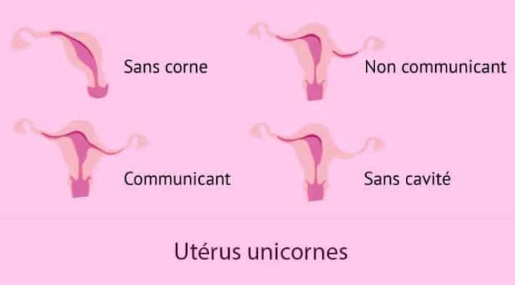 Malformations utérines_utérus unicornes