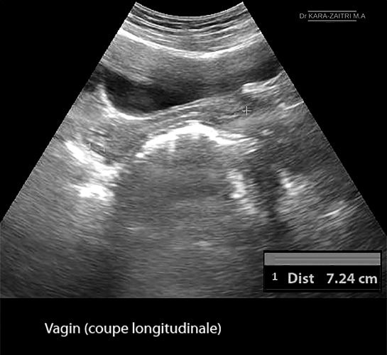 Vagin — anatomie histologie paroi vaginale 1