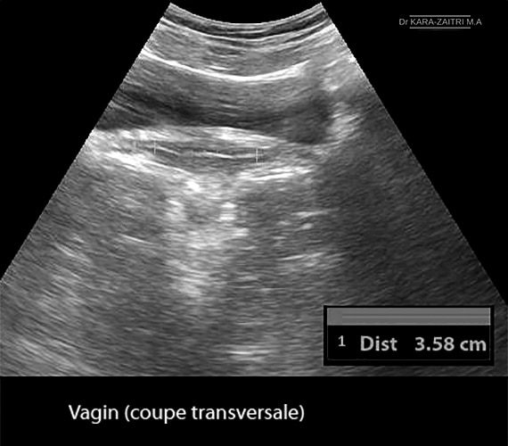 Vagin — anatomie histologie paroi vaginale 2