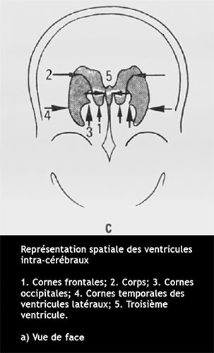 Ventricules cerebraux 2