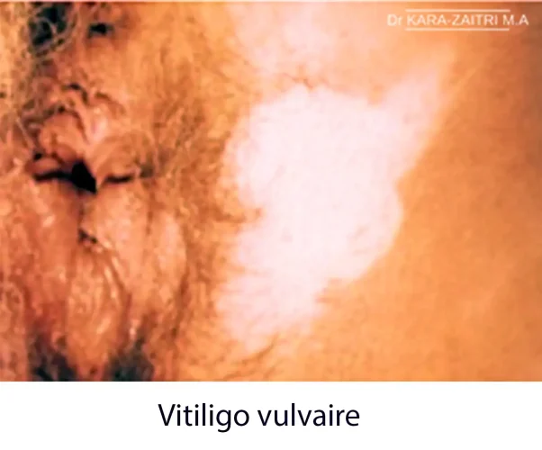 Vitiligo vulvaire — dépigmentation de la vulve