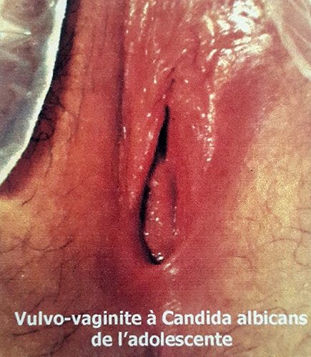 Vulvo-vaginite_candida