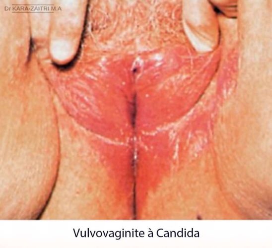 Lésions rouges de la vulve - Vulvovaginite à Candida — aspect clinique infection fongique vaginale