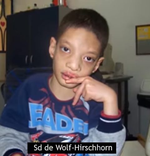 Syndrome de Wolf-Hirschhorn — délétion 4p dysmorphie faciale 6