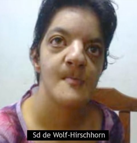 Syndrome de Wolf-Hirschhorn — délétion 4p dysmorphie faciale 7