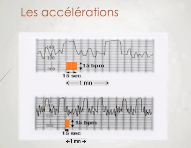 Accélérations du rythme cardiaque fœtal — RCF réactif normal