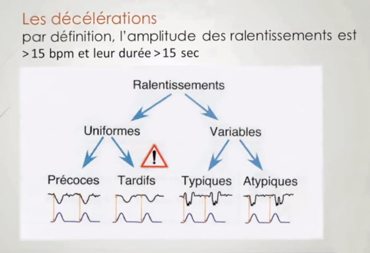 Décélérations du rythme cardiaque fœtal — RCF pathologique