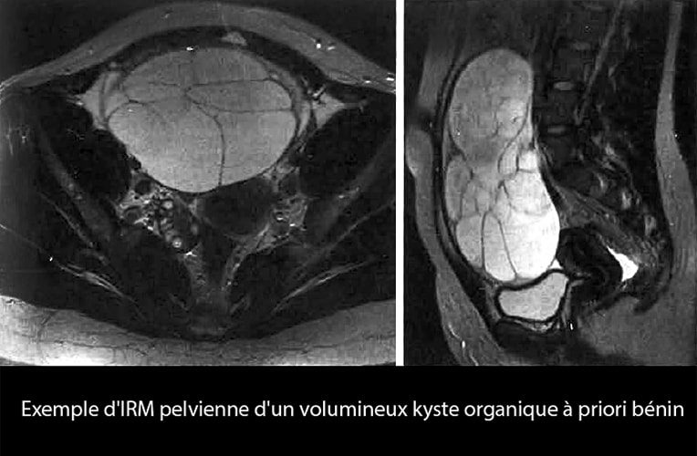 irm_kyste ov